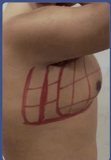 Vista oblicua antes del tratamiento, caso 09, brazo elevado, con marcaje preoperatorio visible