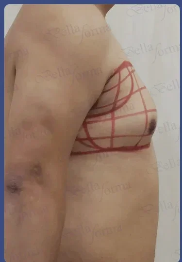Vista lateral antes del tratamiento, caso 10, con marcaje preoperatorio visible