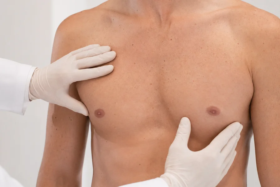 Evaluación médica del pectoral masculino para tratamiento de ginecomastia